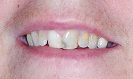 before dental implants